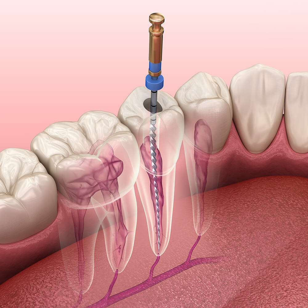 Endodontischer Wurzelkanalbehandlungsprozess - 3D Visualisierung