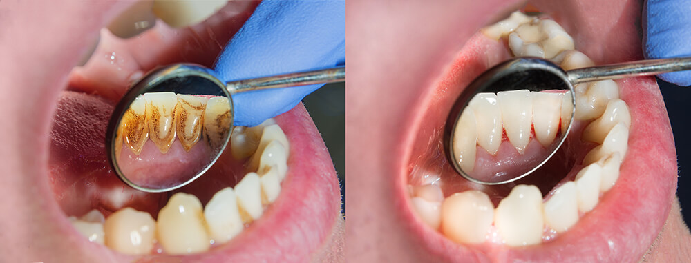 Behandlung von Plaque bei einer professionellen Zahnreinigung
